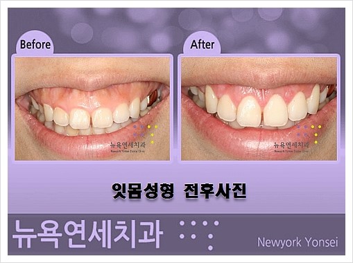  큰 잇몸이 문제라면 잇몸성형으로 치과 치료를 받으세요.