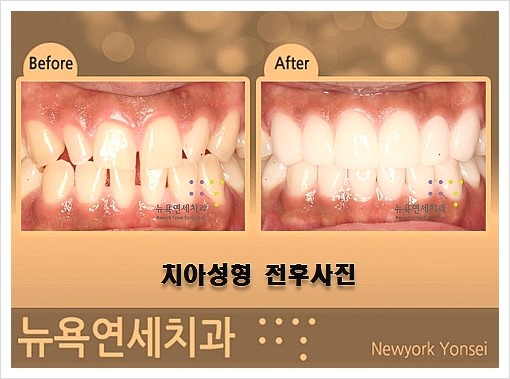  무삭제 라미네이트는 강남역 뉴욕연세치과에서~~