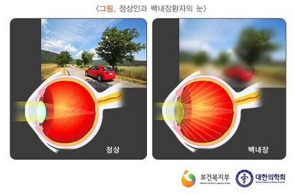 실손보험 환자, 안과에선 호갱? 실손보험 환자, 안과에선 호갱?