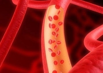 헤모필루스 듀크레이 궤양
