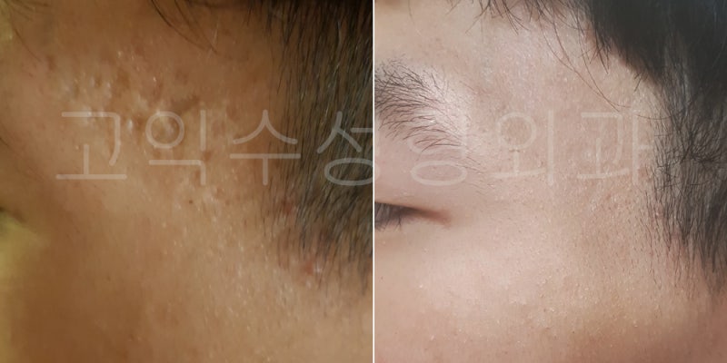 관자놀이 여드름 제거 후기 5