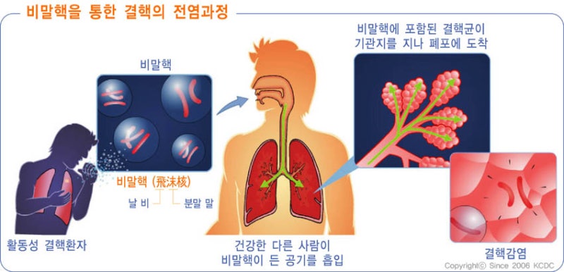 잠복결핵 양성의 경우(치료방법과 기간은?)@ 5