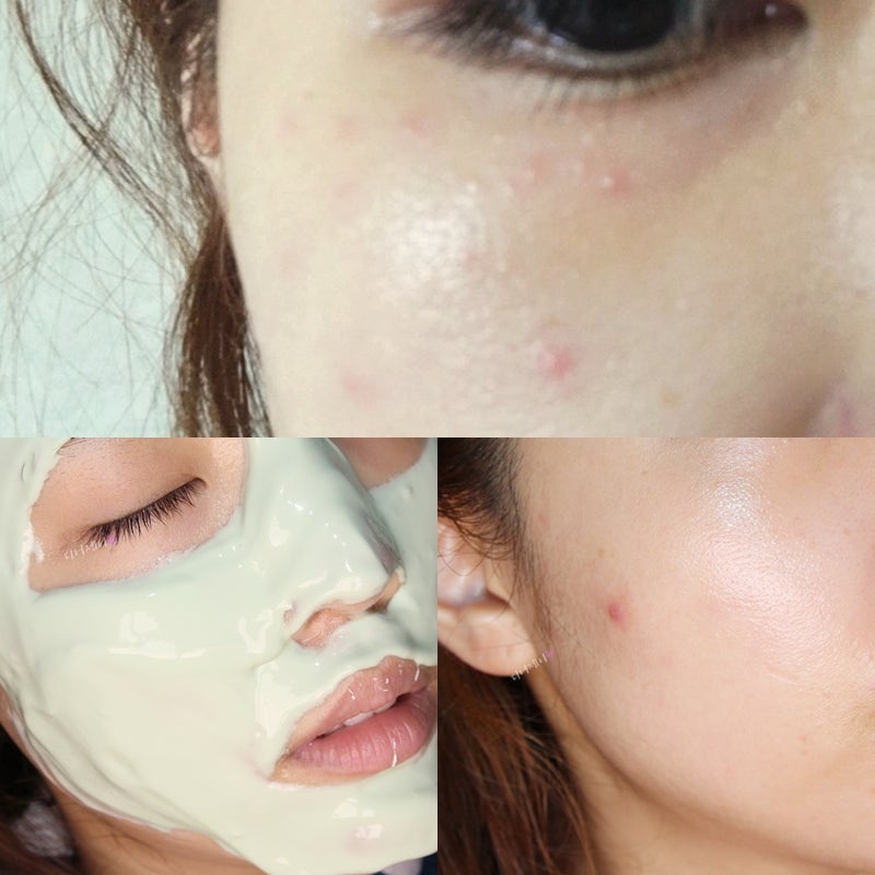 유성 피부관리 뒤집어진피부 진정재생 하고왔어요