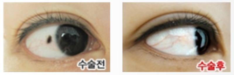 눈 흰자 위의 점-결막모반 원인과 치료는? : 네이버 블로그