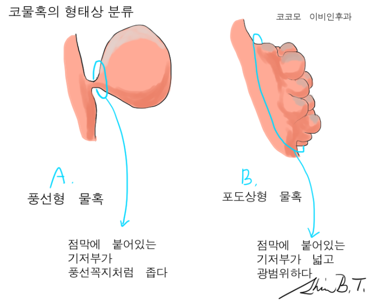  한쪽으로만 발생한 비용종, 코물혹의 종류와 수술