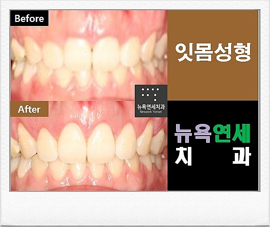  잇몸성형 종류 중 잇몸 라인 성형으로 보기 좋은 스마일라인을 만들기!