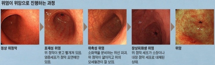 장상피화생과 위암