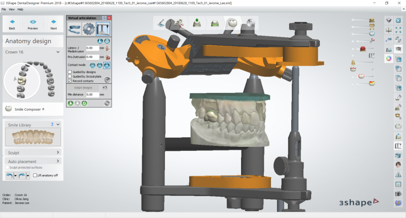 [3Shape Dental System] 2-2. 입문편 Single Crown 디자인 : 네이버 블로그