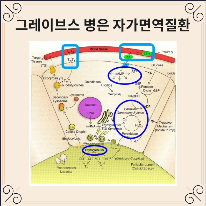 갑상선기능 항진증을 나타내는 그레이브스병은 자가면역질환입니다 네이버 블로그