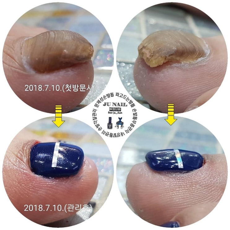 고민고민무좀발톱/분당용인수원수지보정동백죽전동/주네일/파고드는발톱 고민고민무좀발톱/분당용인수원수지보정동백죽전동/주네일/파고드는발톱