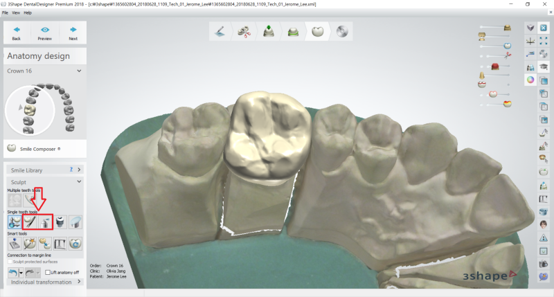 [3Shape Dental System] 2-2. 입문편 Single Crown 디자인 : 네이버 블로그