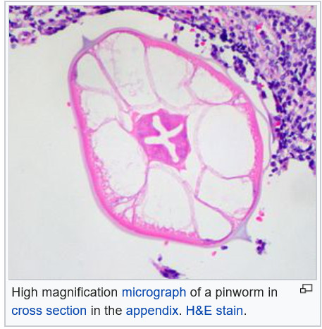 pinworm enterobiasis egy és ugyanaz
