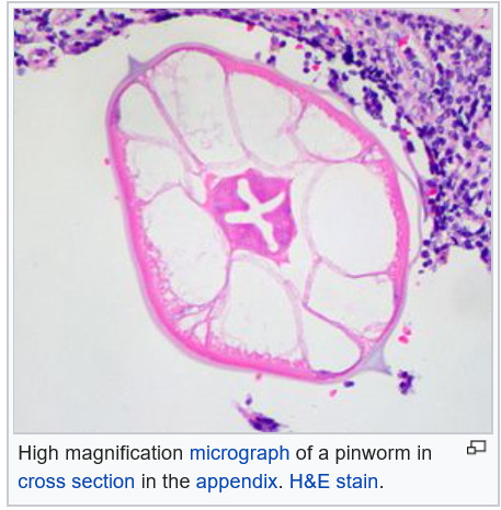 pinworm enterobiasis egy és ugyanaz)