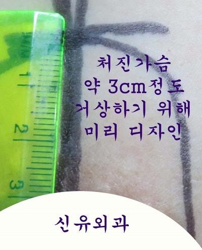 가슴보형물이 뒤집혀서 제거교체하고 처진가슴 끌어올리는 거상술도