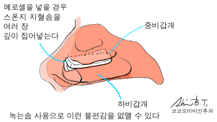  코물혹수술과 축농증수술에서 핵심 포인트