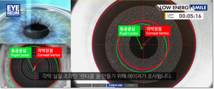 스마일라식수술의 정확성을 높인 SCI 논문 발표