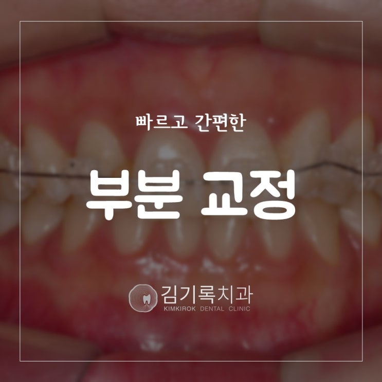 수원앞니교정 동탄교정치과 빠르고 간편하고 합리적인 앞니부분교정