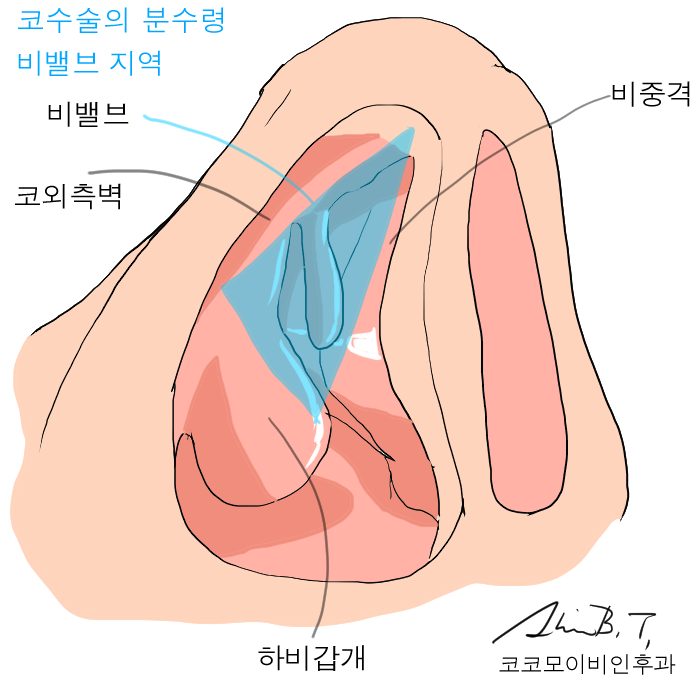  비중격만곡증수술후기, 의사가 회고해보는 치료의 전과정