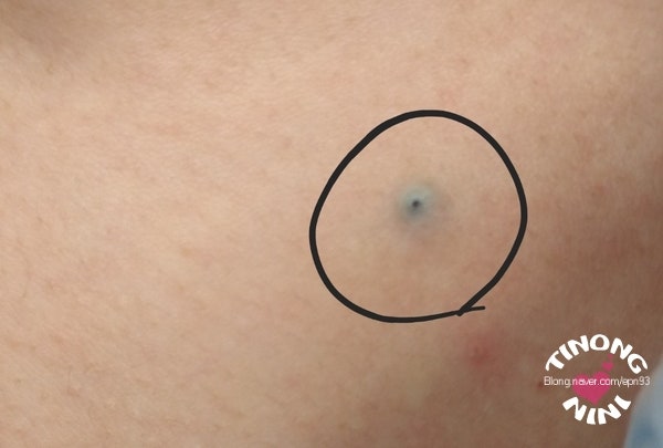 조기 피지낭종 수술의 이유