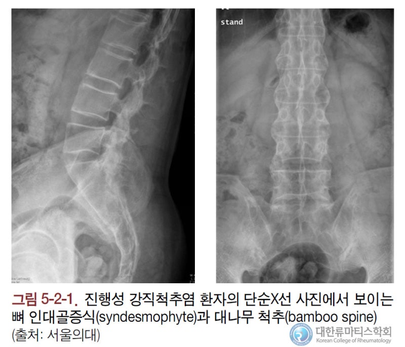 강직성 척추염의 병원진단과 치료 및 적절한 기술 5