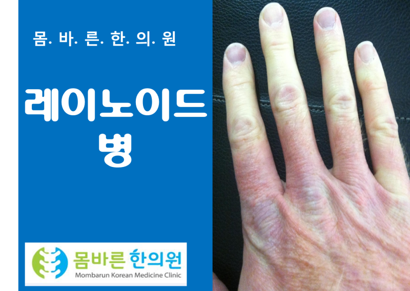 레이노이드 병(수족냉증)[몸바른 한의원]