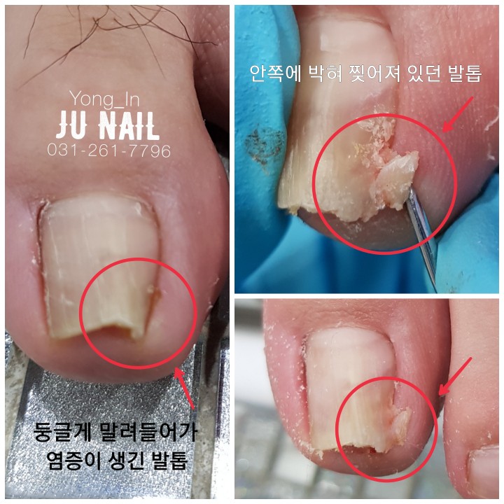 염증가득아픈발톱/분당용인수원수지보정동백죽전동/주네일/파고드는내향성발톱 염증가득아픈발톱/분당용인수원수지보정동백죽전동/주네일/파고드는내향성발톱