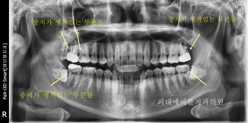 20대 대구치 임플란트 수술의 핵심 체크포인트 5가지 2
