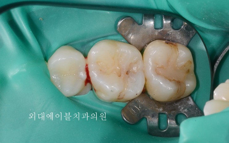 성신여대 치과, 치아 충치치료 및 재치료