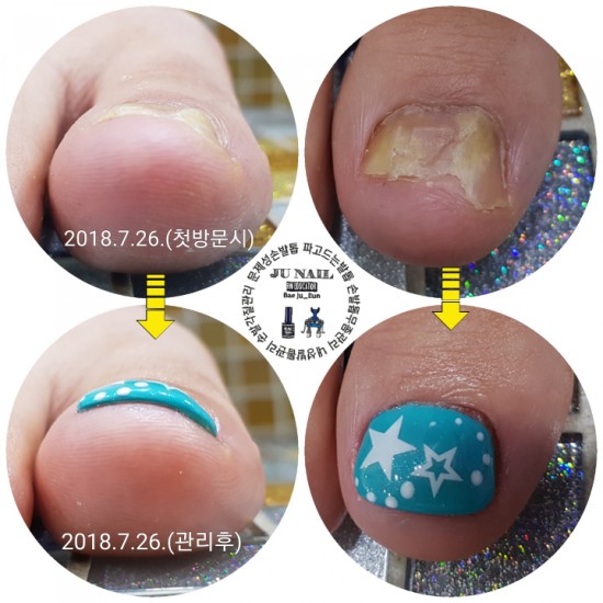 무좀발톱감쪽같이/분당용인수원수지보정동백죽전동/주네일/파고드는발톱 무좀발톱감쪽같이/분당용인수원수지보정동백죽전동/주네일/파고드는발톱