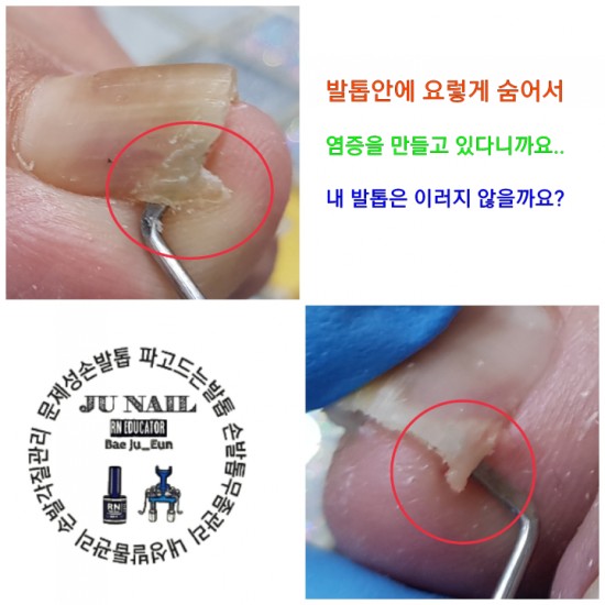 발톱이파고들어아픈이유/분당용인수원수지보정동백죽전동/주네일/파고드는내향성발톱