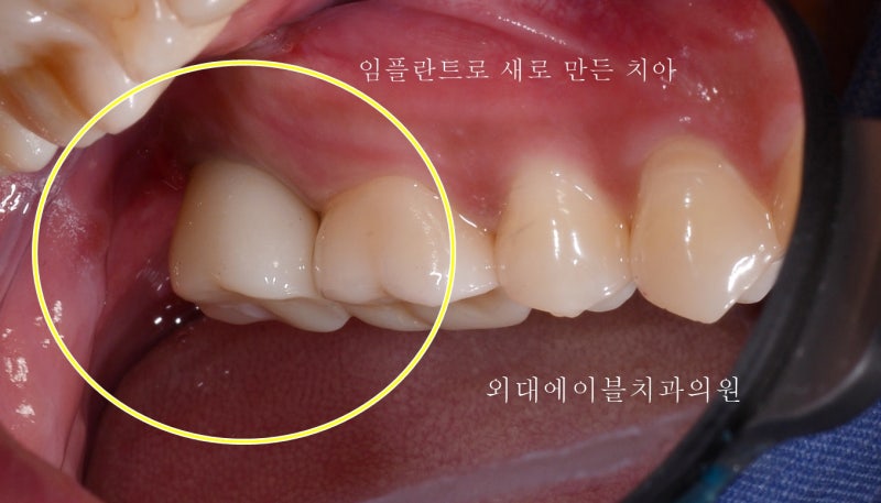 20대 대구치 임플란트 수술의 핵심 체크포인트 5가지