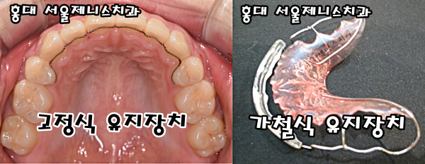 교정유지장치/ 치아교정후 유지장치철사떨어짐/ 유지장치 재제작 : 네이버 블로그 교정유지장치/ 치아교정후 유지장치철사떨어짐/ 유지장치 재제작 : 네이버 블로그