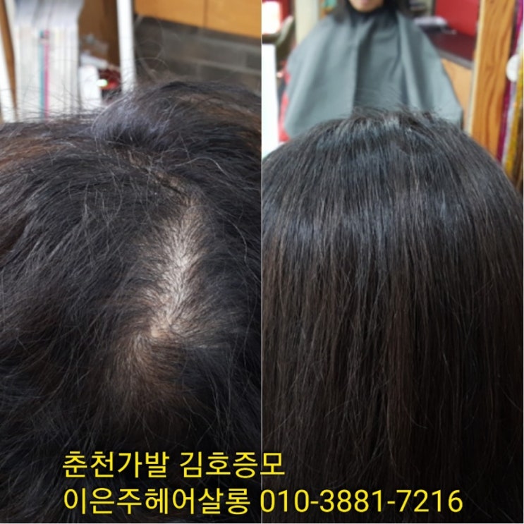  춘천가발 김호증모 앞머리 가르마 탑볼륨 숱보강 다증모술과 보톡스증모술의 콜라보레이션~