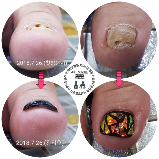 무좀발톱이제당당하게시원하게../분당용인수원수지보정동백죽전동/주네일/파고드는발톱 무좀발톱이제당당하게시원하게../분당용인수원수지보정동백죽전동/주네일/파고드는발톱
