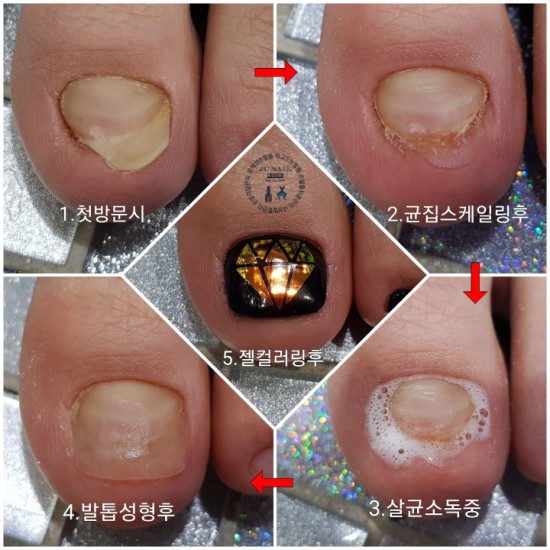 변형되고아픈발톱/분당용인수원수지보정동백죽전동/주네일/파고드는발톱 변형되고아픈발톱/분당용인수원수지보정동백죽전동/주네일/파고드는발톱