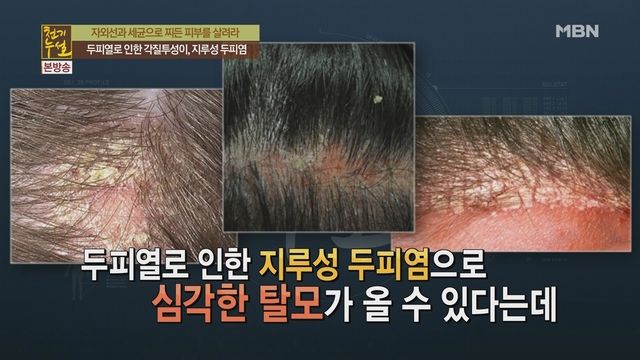  뜨거운 두피 NO! 두피열 내리는 방법 - 탄현/제니스/덕이/운정 바른미술학원