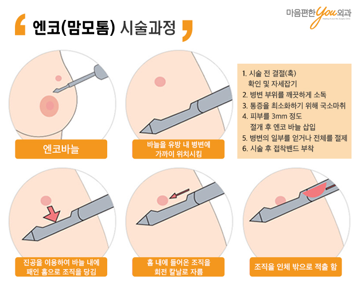 맘모톰수술병원추천 조기발견 중요한 이유 4