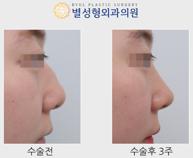 Dr. 아베크 [코성형] 복비수술, 코끝과 콧날개