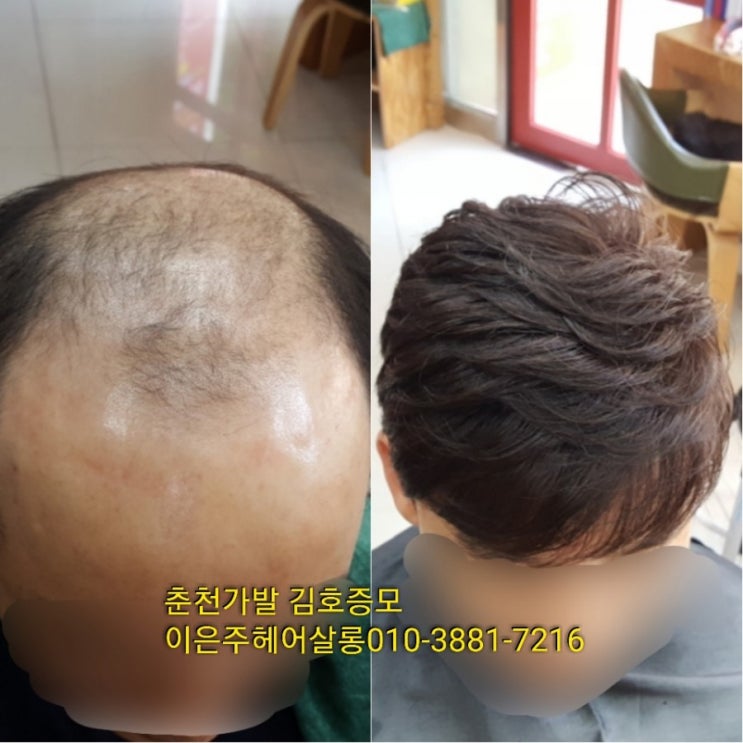  춘천가발 김호증모 이은주헤어살롱에서 맞춤같은 기성가발로 당일가발 합니다~^^