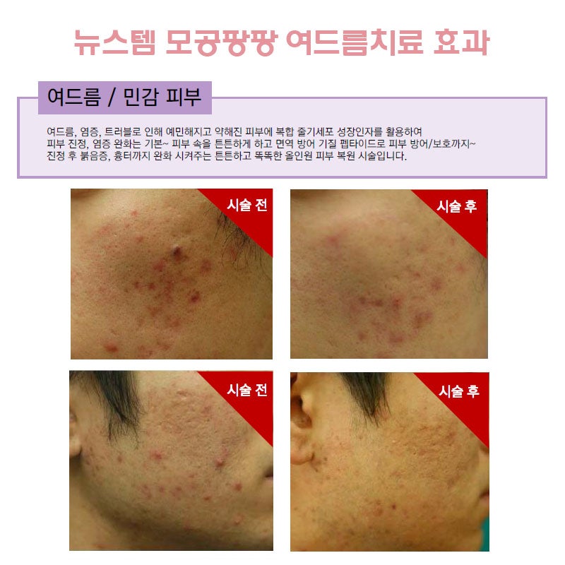 여드름치료 속부터 건강하게