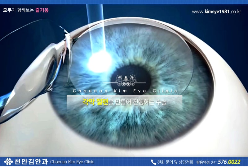 각막 두께와 라식의 관계 : 네이버 블로그