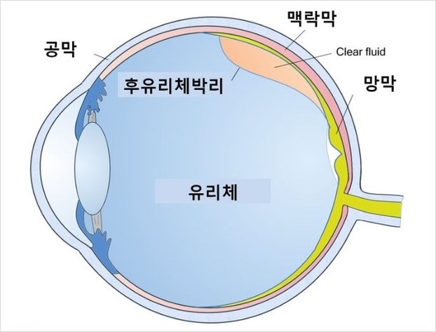 비문증과 백내장, 관계가 있을까요?