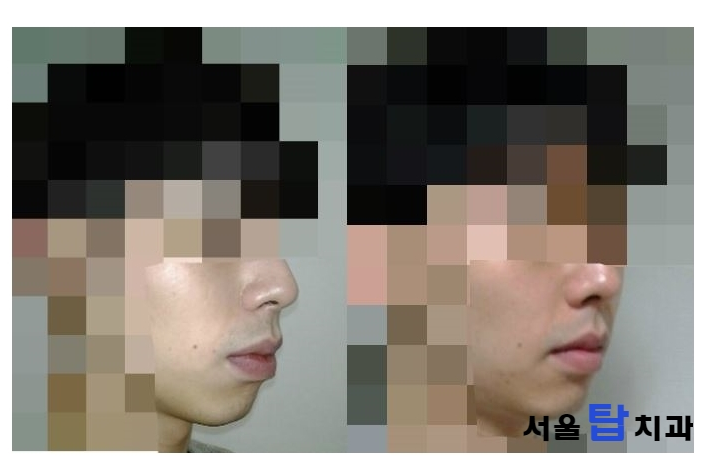 치아교정 얼굴형 변화 - 치아교정 얼굴변화 효과는? : 네이버 블로그 치아교정 얼굴형 변화 - 치아교정 얼굴변화 효과는? : 네이버 블로그
