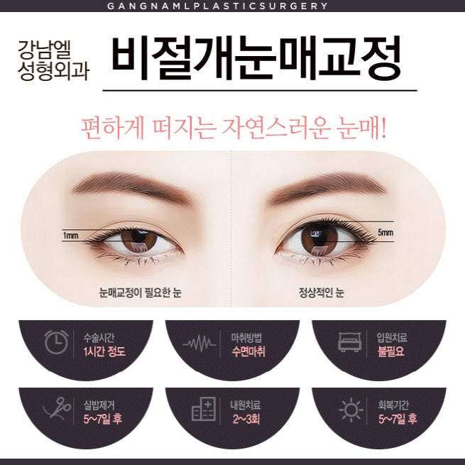 대전눈매교정 수술 잘하는 병원! 3