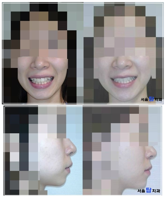 치아교정 얼굴형 변화 - 치아교정 얼굴변화 효과는? : 네이버 블로그 치아교정 얼굴형 변화 - 치아교정 얼굴변화 효과는? : 네이버 블로그