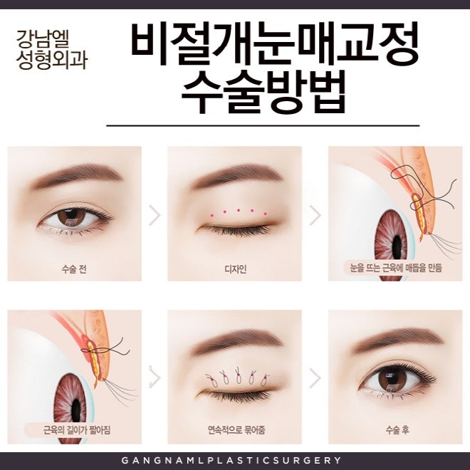 대전눈매교정 수술 잘하는 병원! 4