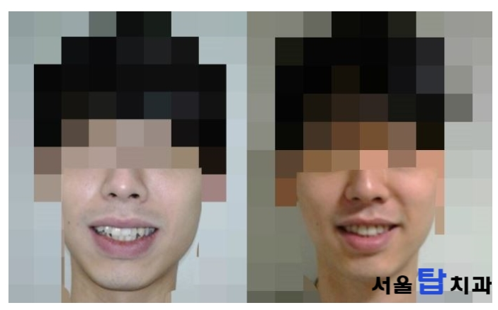 치아교정 얼굴형 변화 - 치아교정 얼굴변화 효과는? : 네이버 블로그