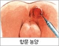 항문농양 제거수술 꼭 해야할까? : 네이버 블로그 항문농양 제거수술 꼭 해야할까? : 네이버 블로그