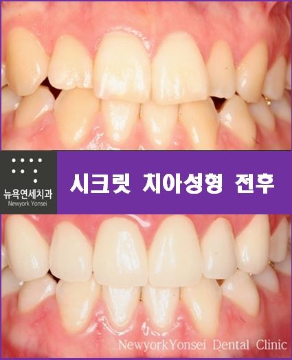  앞니 치아성형 꼭 필요한 경우는