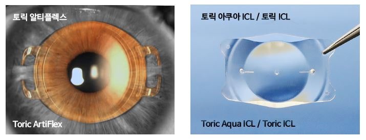 렌즈삽입술 난시교정, 효과와 주의사항은?